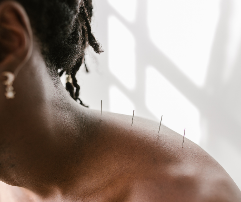acupuncture